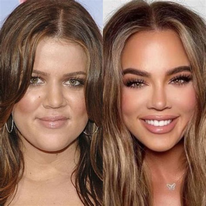 Khloe Kardashian Plastic Surgery: Did She Get A Nose Job?
